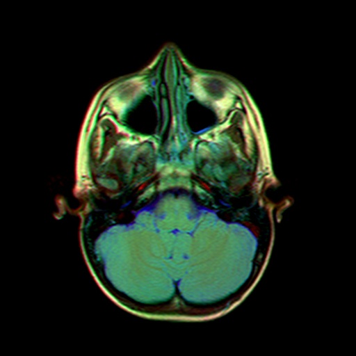 Brain MRI img